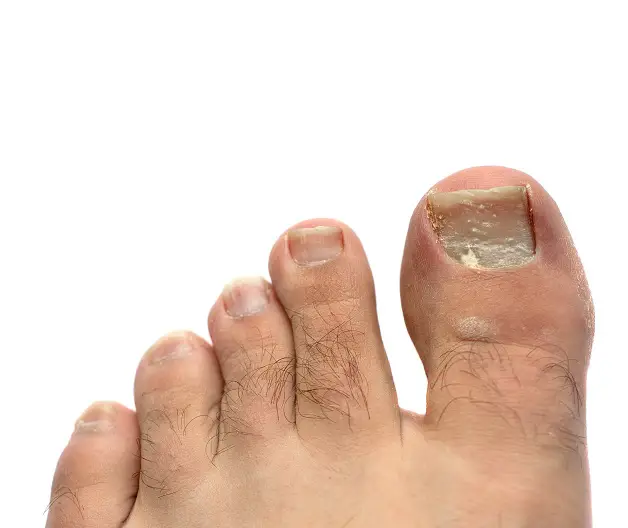 toes with a cracked and peeling toe