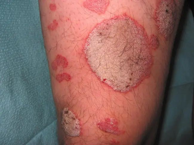 psoriasis types of Psoriasis, Symptoms, Treatment and Remedies