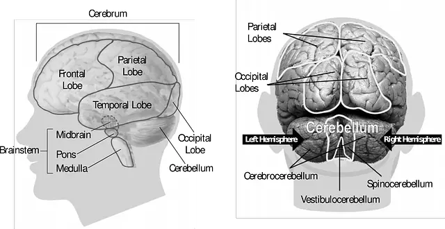 brain Encephalomalacia