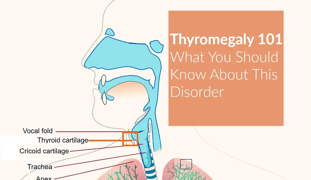 Thyromegaly