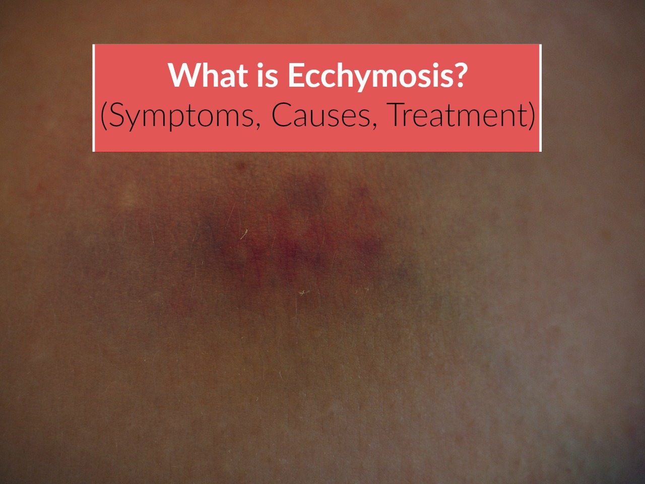What is Ecchymosis