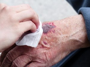 hand Ecchymosis