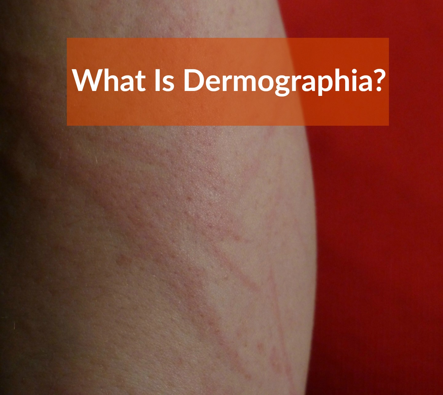 what is Dermographia