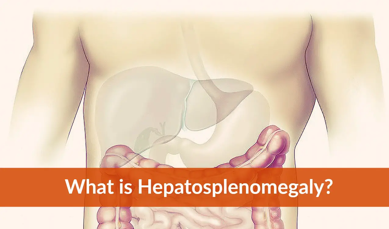 what is hepatosplenomegaly