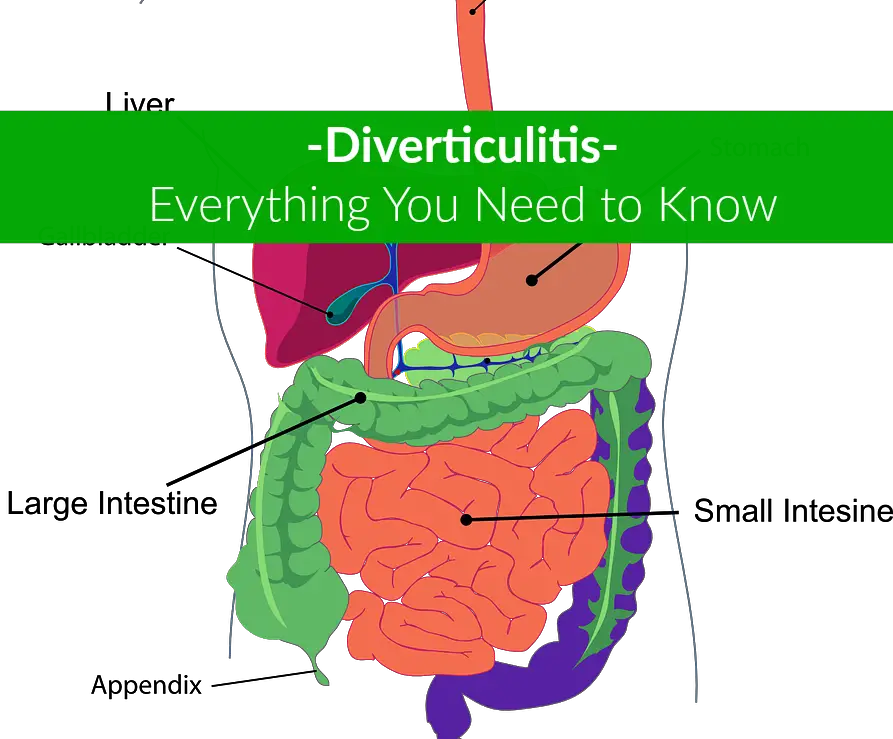 di-verticulitis