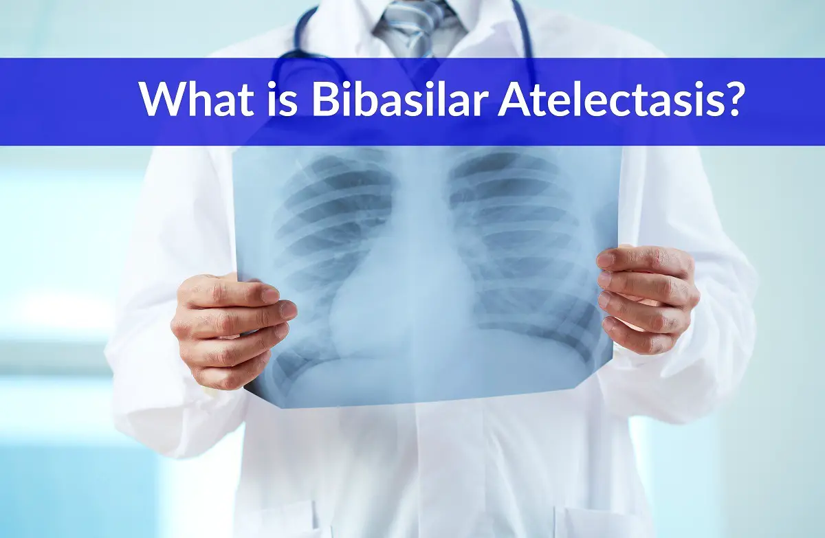 What is Bibasilar Atelectasis