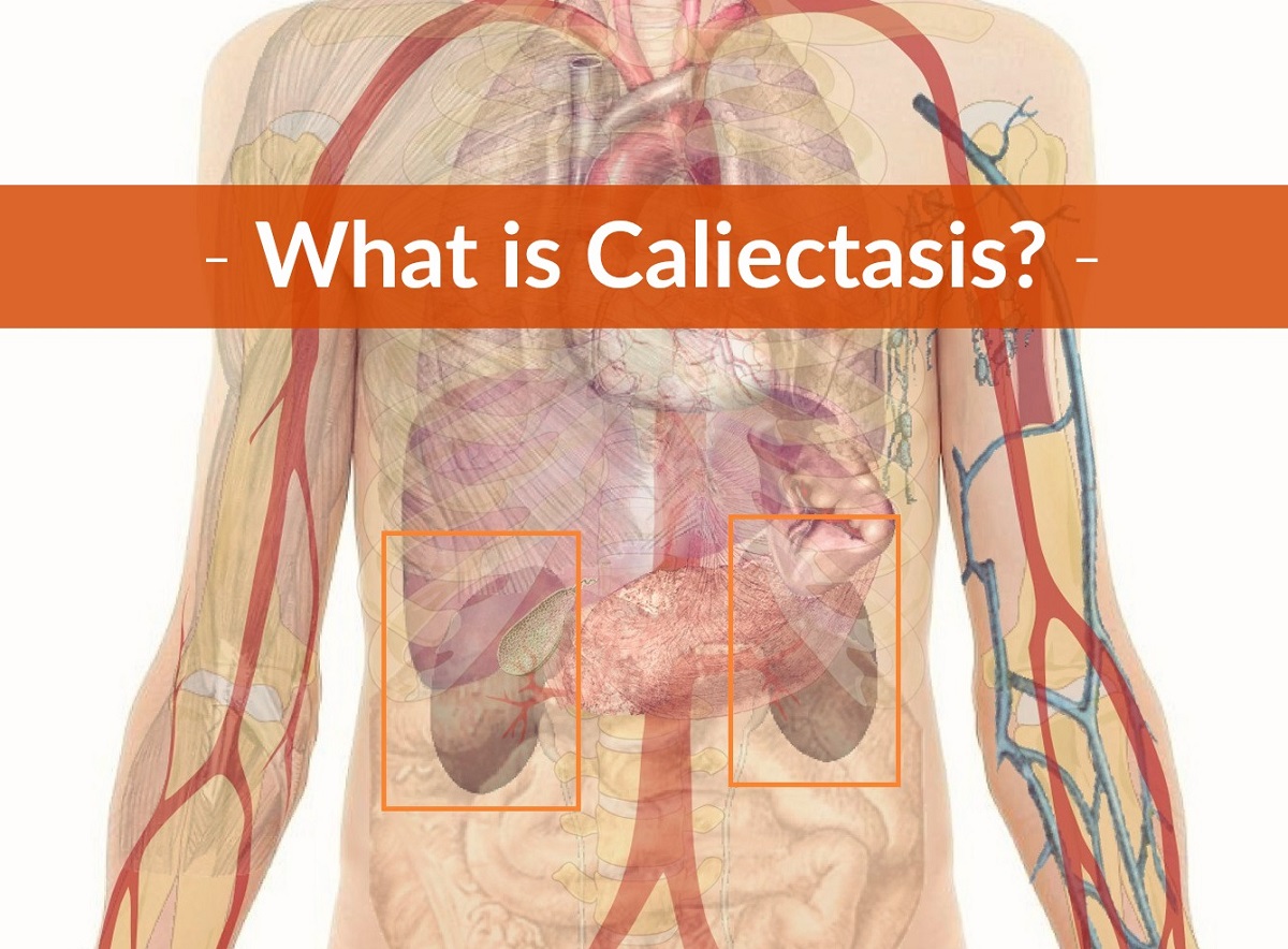 What is Caliectasis