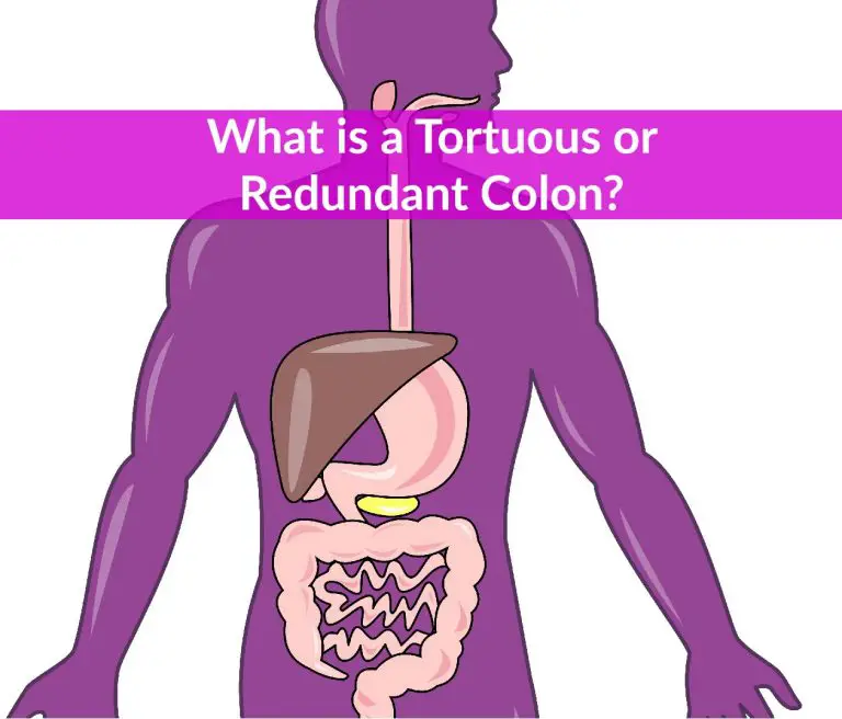 Tortuous Colon Diet, Symptoms, Diagnosis, Treatment