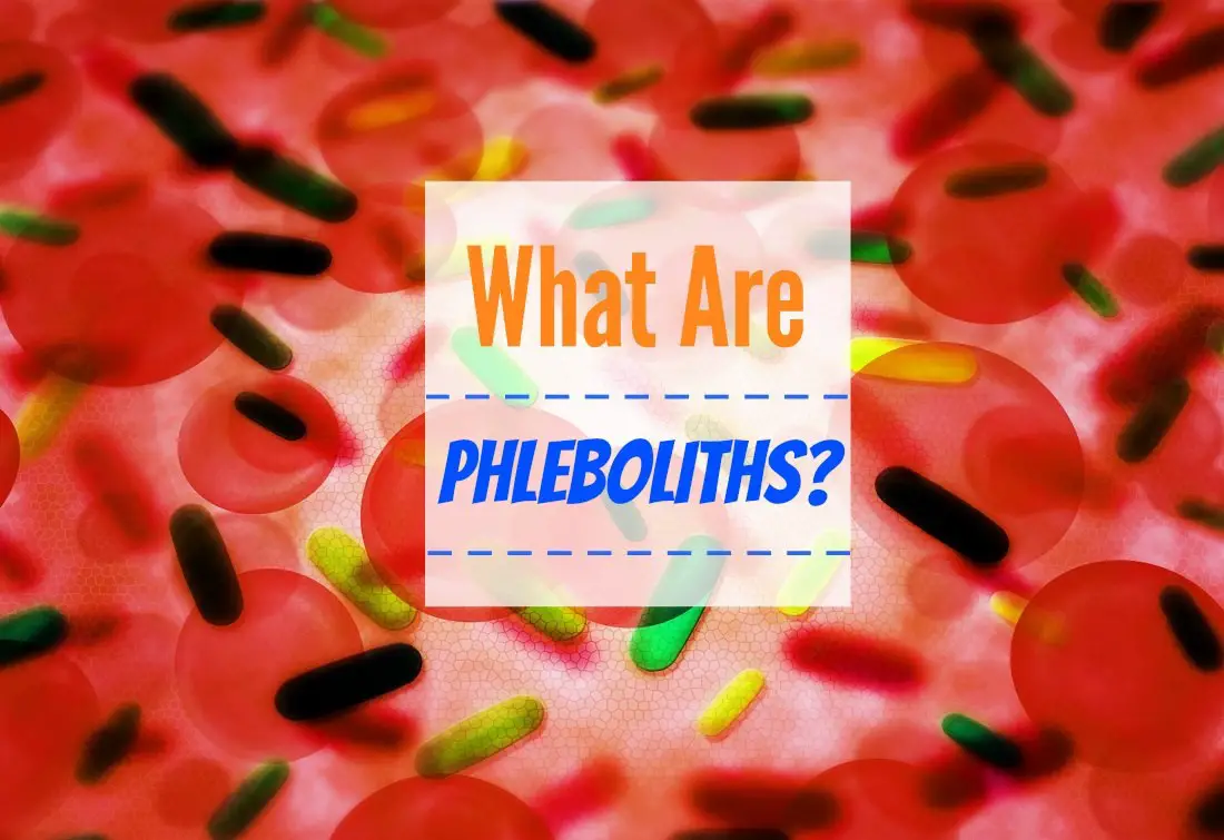 what are phleboliths